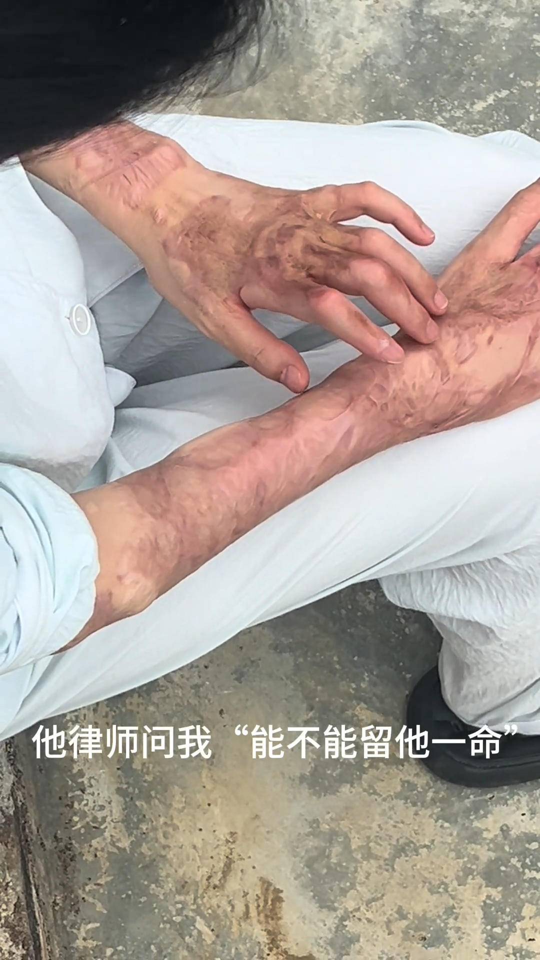 ▲被硫酸严重腐蚀的双手 兰女士社交平台发布视频的画面
