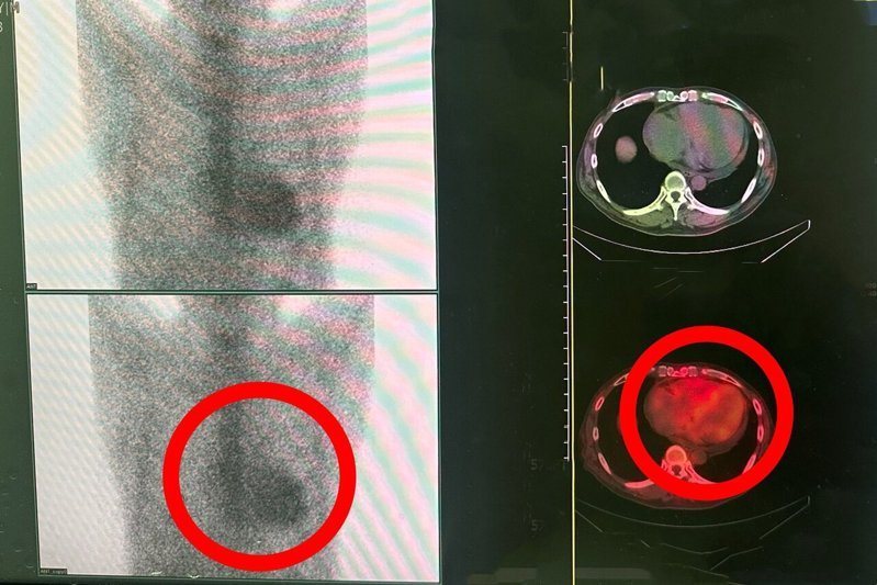 （左圖）平面影像顯示心肌呈現強烈的放射性同位素攝取，且其攝取強度超過肋骨的攝取量。</p><!--6--><p>
（右圖）單光子電腦斷層掃描（SPECT/CT）影像顯示放射性藥物明顯且均勻地沉積在左心室心肌壁，而非滯留於心室腔內的血液池中。圖／衛福部豐原醫院提供